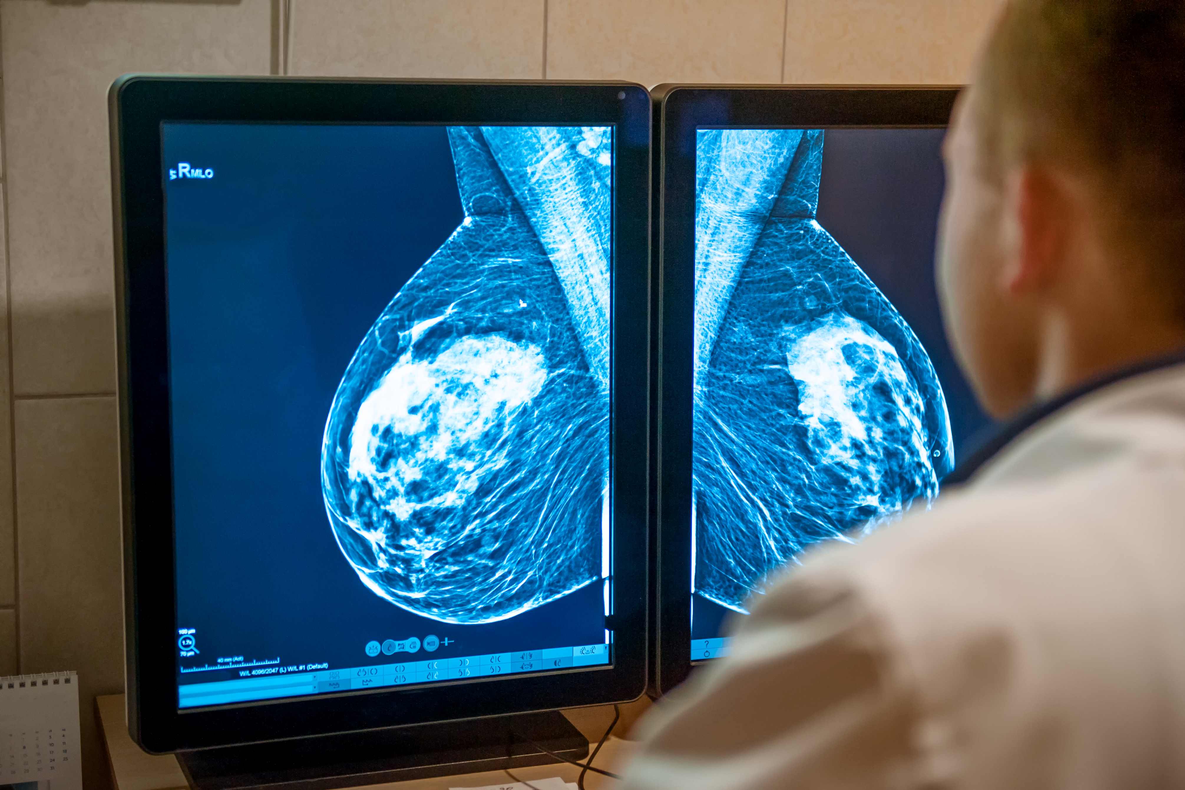Triple-negative breast cancer is aggressive, harder to treat, and more likely to spread to other organs.